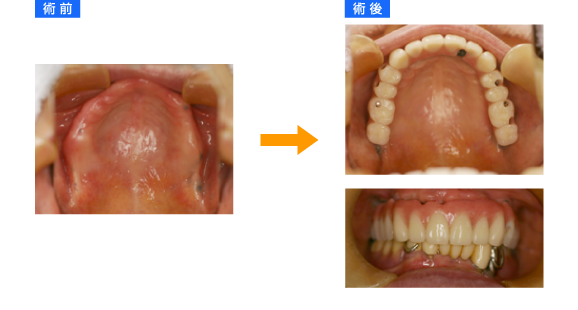 上顎全歯インプラント 術前術後1