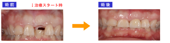 抜歯即時埋入