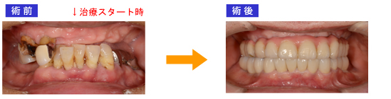 上顎全歯インプラント