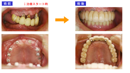 上顎前歯インプラント 術前術後