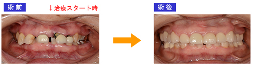 抜歯即時埋入