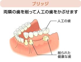 ブリッジ