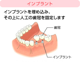 インプラント治療