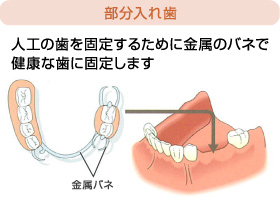 部分入れ歯
