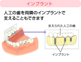 インプラント治療2