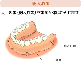総入れ歯