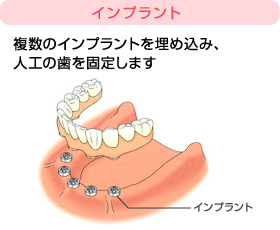 インプラント治療3