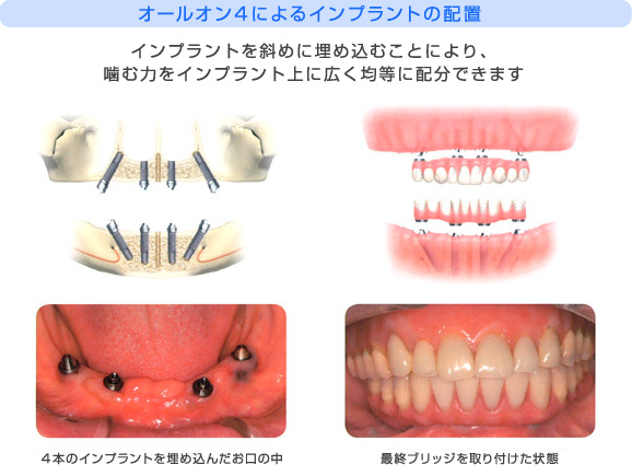 オールオン4によるインプラントの配置画像