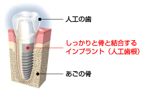 インプラント治療画像