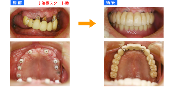 上顎全歯インプラント 術前術後2